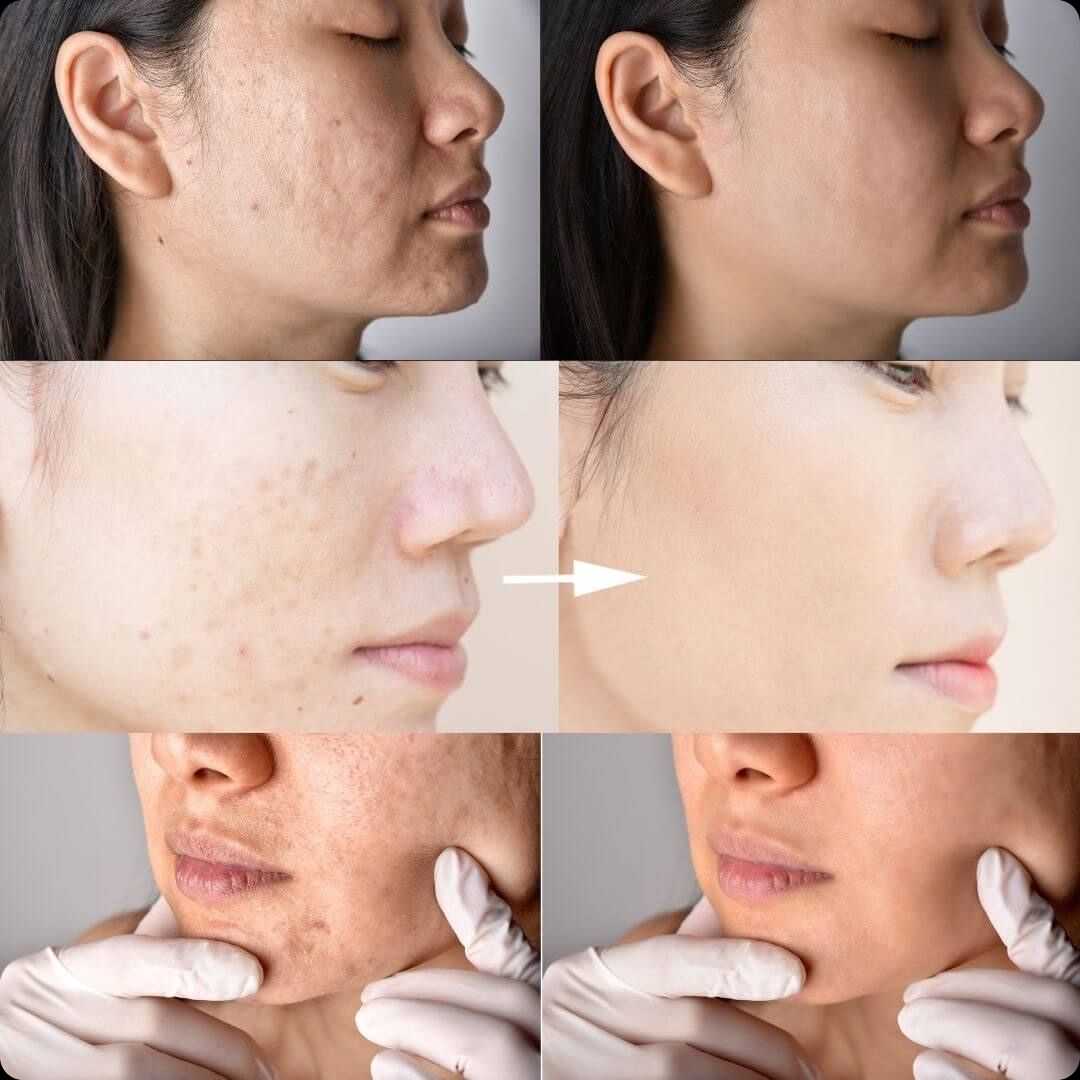 SERUM 10 ANTIACNÉ -🎁 PAGA 1 Y LLEVA 2