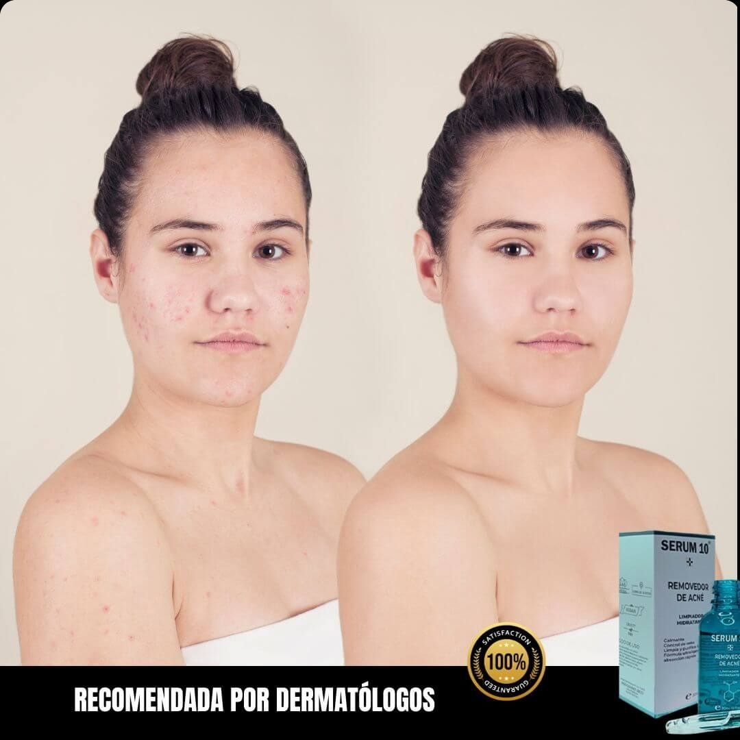 SERUM 10 ANTIACNÉ -🎁  PAGA 1 Y LLEVA 2