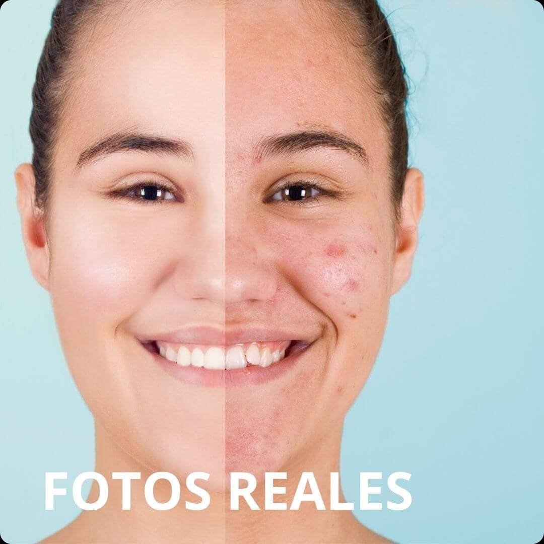 SERUM 10 ANTIACNÉ -🎁  PAGA 1 Y LLEVA 2