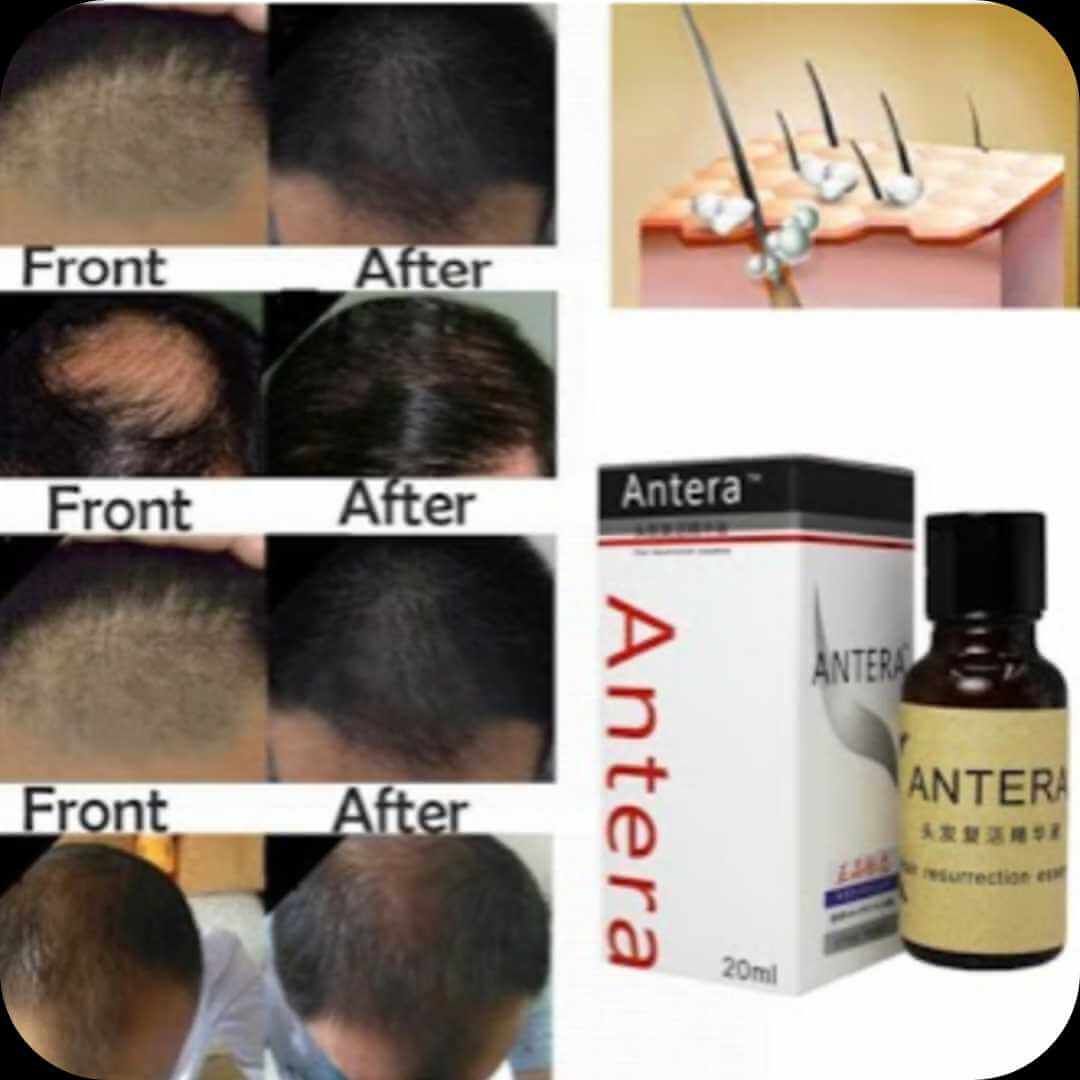 🎁 AnteraGrowth + Champú GRATIS